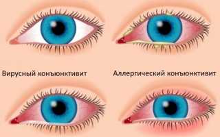 Конъюнктивит: симптомы и причины возникновения заболевания глаз