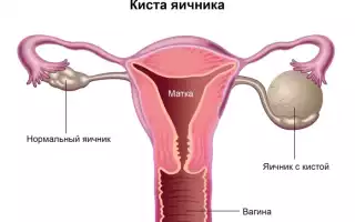 Лютеиновая киста левого яичника