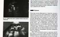 Гиперэхогенные включения в почках