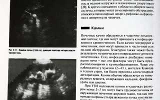 Гиперэхогенные включения в почках