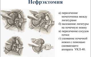 С одной почкой дают инвалидность