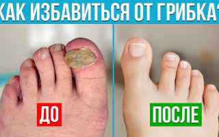 Как распознать и избавиться от грибка ногтей навсегда