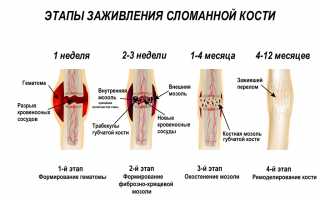 Почему не заживает перелом? Причины и советы