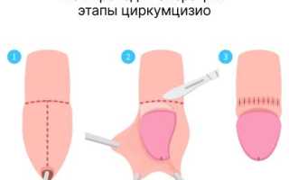 Зачем мужчине делать обрезание, какие преимущества оно дает для здоровья