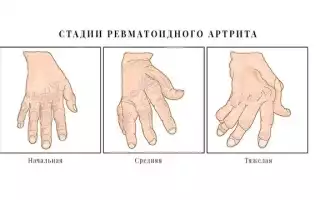 Ранние признаки, которые предупреждают о ревматоидном артрите: важные детали