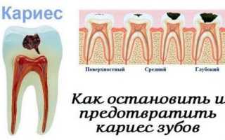 Как избежать кариеса после 30 лет: полезные советы