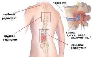 Боль в спине: чем отличается остеохондроз от радикулита и как с этим справиться