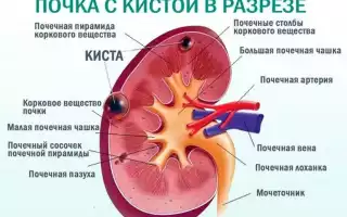 Киста синуса левой почки что это такое