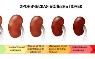 Нефроангиосклероз почек лечение