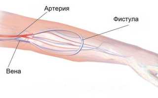 Фистула при гемодиализе