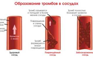 Как образуются тромбы и что поможет их обнаружить: важные факты