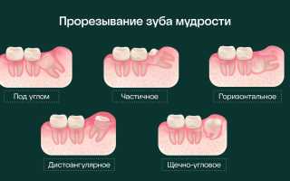 Зачем растут зубы мудрости и надо ли их удалять: мнение стоматологов