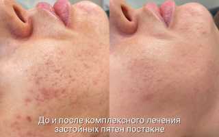 Постакне профилактика и способы устранения для здоровой кожи