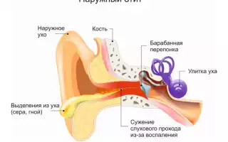 Как лечить отит? Полезные советы и рекомендации