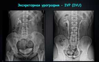 Урография у детей как делается
